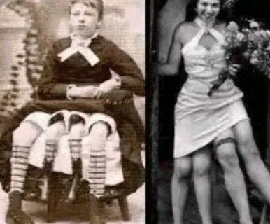 True Story Of Josephine Myrtle Corbin, The Lady Born With Four Legs & Two Private Parts (Photos)